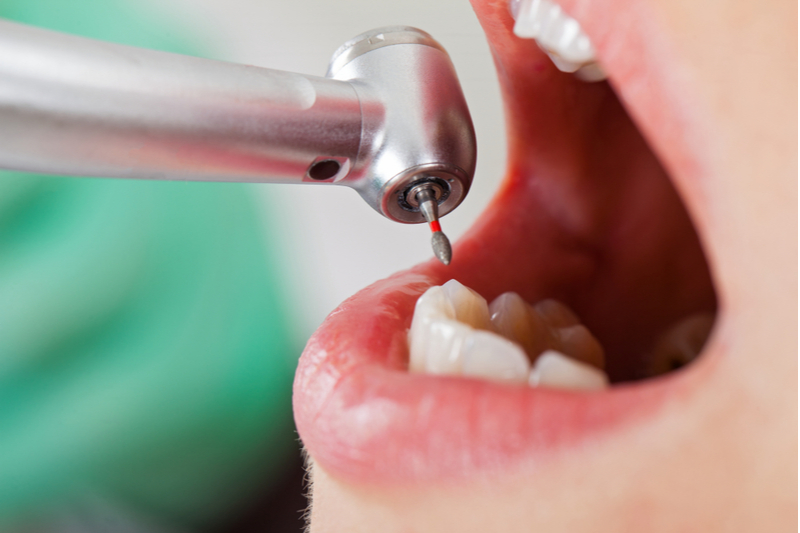 虫歯治療で使われる麻酔の種類と効果