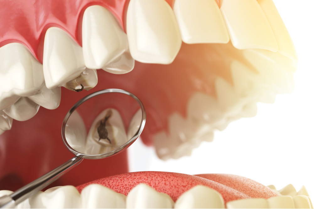 金属アレルギーでも虫歯治療は受けられる！おすすめの治療方法を紹介